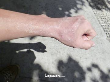 2013年07月25日，西藏自治区拉萨市，暴露在紫外线下的结果。by Lopwon